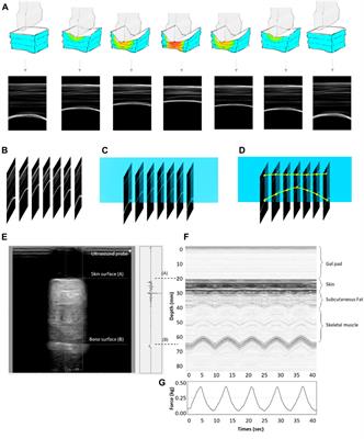 Effect of negative pressure therapy on the treatment response to scar thickness and viscoelasticity